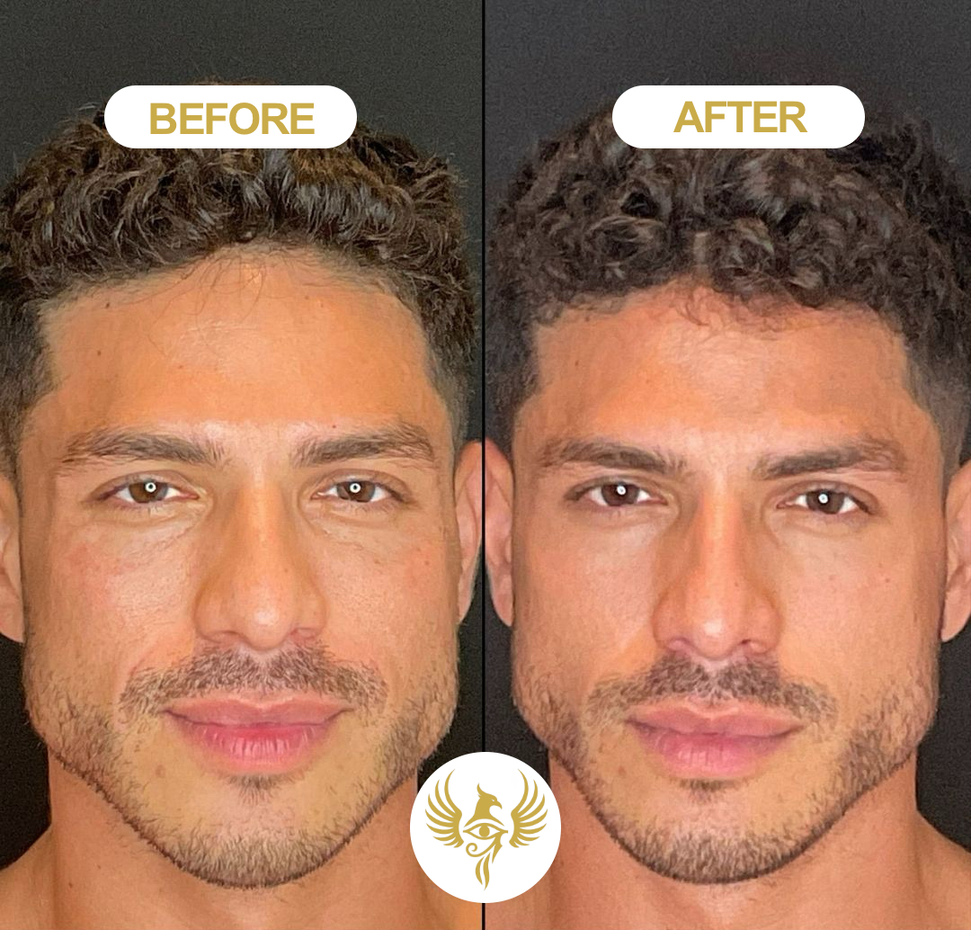 Before and after body sculpting